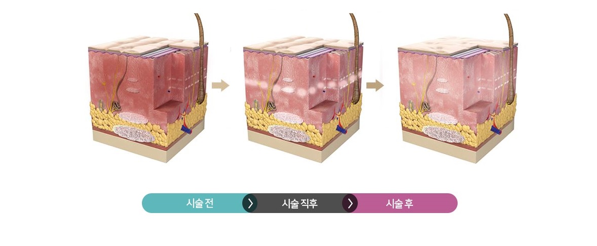 물광주사22